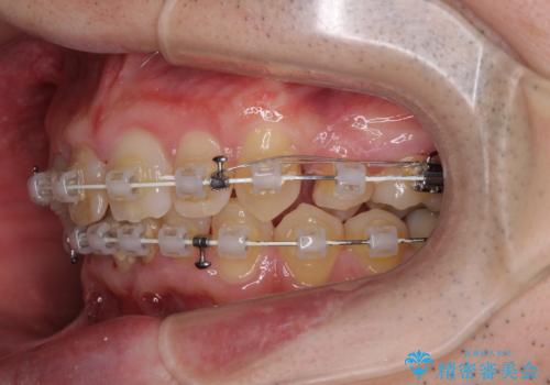 前歯が折れたついでに歯並びも改善 矯正治療と前歯のセラミック治療の治療中