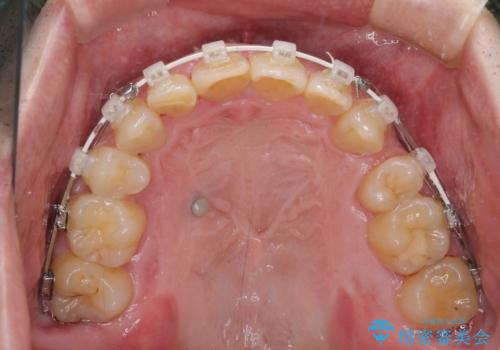 前歯が折れたついでに歯並びも改善　矯正治療と前歯のセラミック治療の治療中