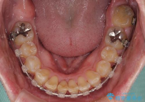 前歯が折れたついでに歯並びも改善 矯正治療と前歯のセラミック治療の治療中