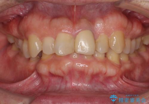 欠損歯列の矯正治療とインプラント治療の症例 治療前