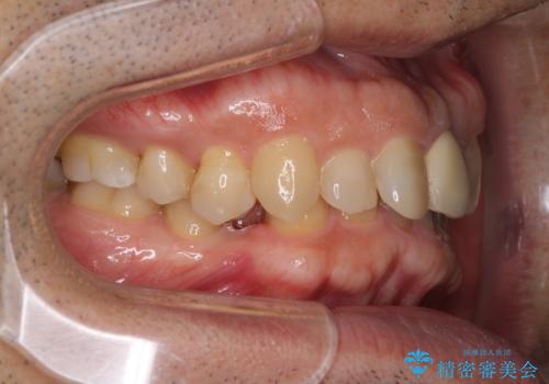 欠損歯列の矯正治療とインプラント治療の治療前