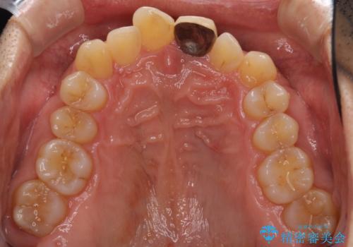 欠損歯列の矯正治療とインプラント治療の治療前