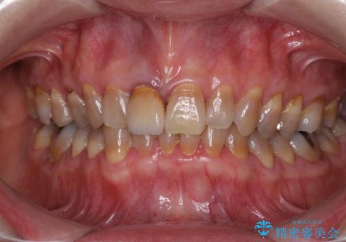 咬み合わせを治したい インビザラインによる矯正治療の症例 治療前