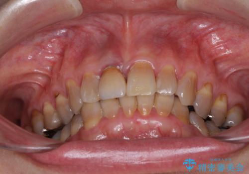 咬み合わせを治したい インビザラインによる矯正治療の治療前