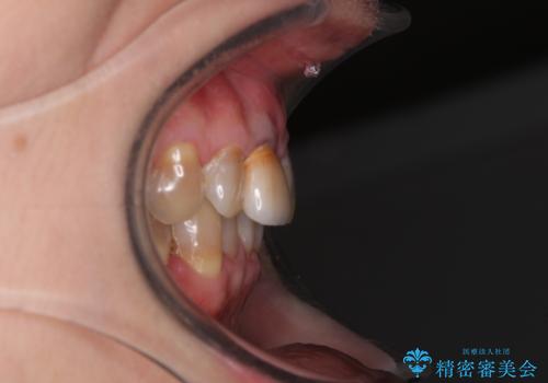 咬み合わせを治したい インビザラインによる矯正治療の治療前