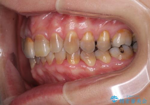 咬み合わせを治したい インビザラインによる矯正治療の治療前