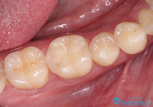 冷たいものがしみる 奥歯のセラミックインレーの症例 治療後