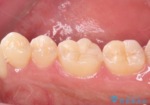 冷たいものがしみる 奥歯のセラミックインレーの治療後