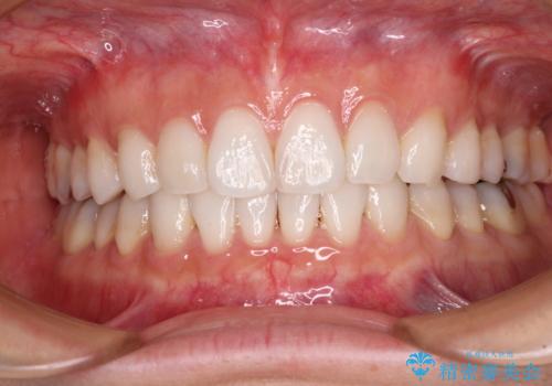 海外で仕事をしながらインビザラインで矯正治療の治療中