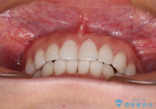 海外で仕事をしながらインビザラインで矯正治療の治療中