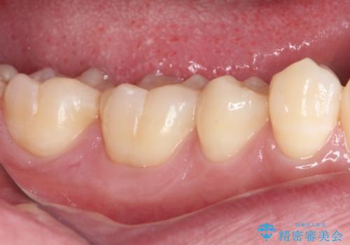 冷たいものがしみる 奥歯のセラミックインレーの治療後