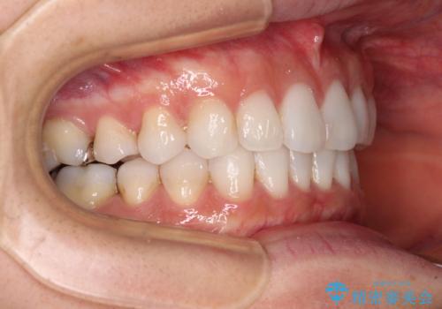 海外で仕事をしながらインビザラインで矯正治療の治療中