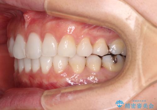 海外で仕事をしながらインビザラインで矯正治療の治療中