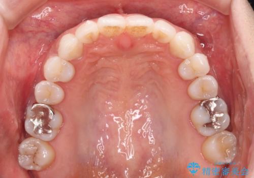 海外で仕事をしながらインビザラインで矯正治療の治療中