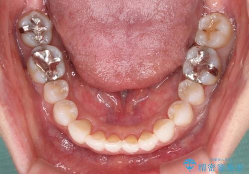 海外で仕事をしながらインビザラインで矯正治療の治療中