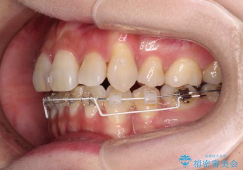 気になる八重歯を目立たない装置で改善　ハーフリンガル矯正の治療中