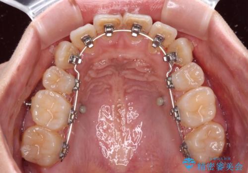 気になる八重歯を目立たない装置で改善　ハーフリンガル矯正の治療中