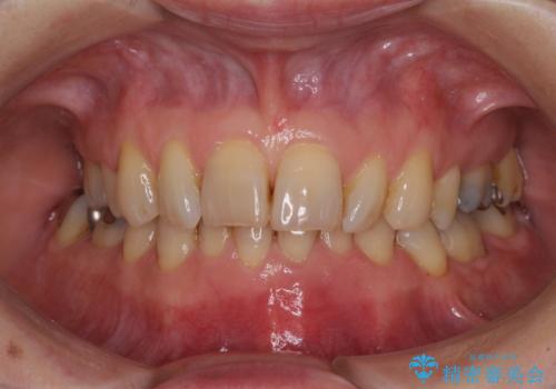 抜歯が必要と言われた前歯　根管治療とオールセラミッククラウンの治療前