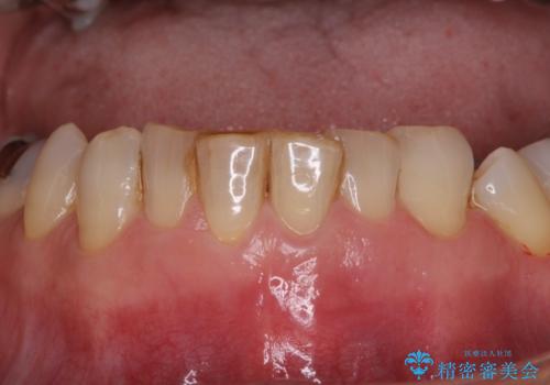 抜歯が必要と言われた前歯　根管治療とオールセラミッククラウンの症例 治療前