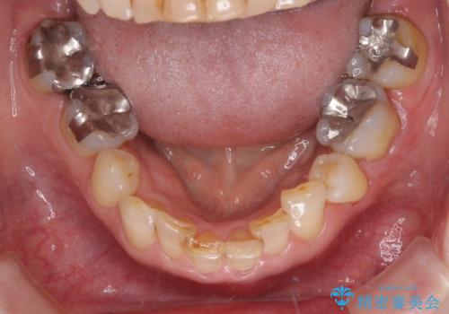 抜歯が必要と言われた前歯　根管治療とオールセラミッククラウンの治療前