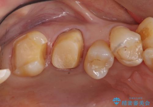 奥歯の銀歯、プラスチックのやりかえの治療中