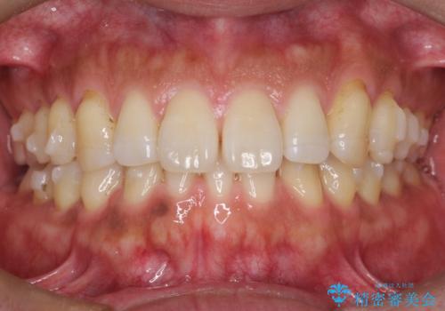『前歯のすき間を短期間で治したい』インビザライン(枚数制限あり)症例の治療中