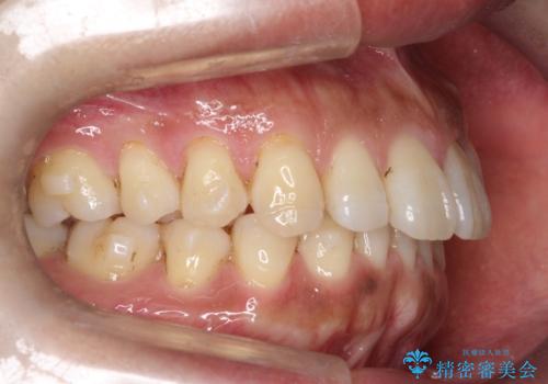 『前歯のすき間を短期間で治したい』インビザライン(枚数制限あり)症例の治療中