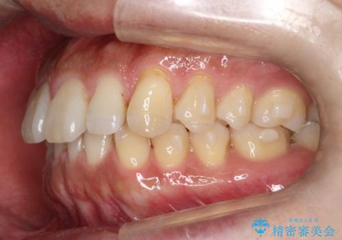 『前歯のすき間を短期間で治したい』インビザライン(枚数制限あり)症例の治療中