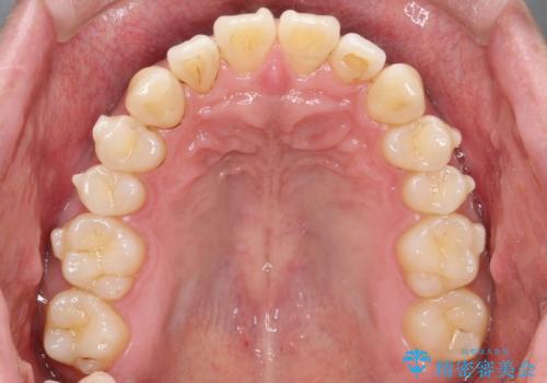 『前歯のすき間を短期間で治したい』インビザライン(枚数制限あり)症例の治療中