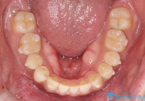 『前歯のすき間を短期間で治したい』インビザライン(枚数制限あり)症例の治療中