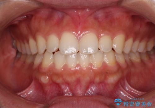 インビザラインを用いた上顎の部分矯正の治療中