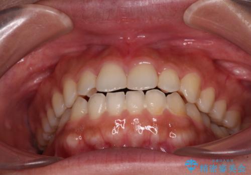 インビザラインを用いた上顎の部分矯正の治療中