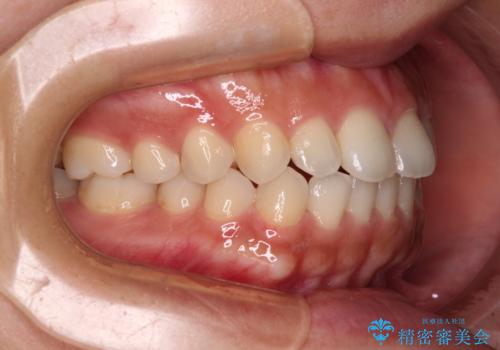 インビザラインを用いた上顎の部分矯正の治療中