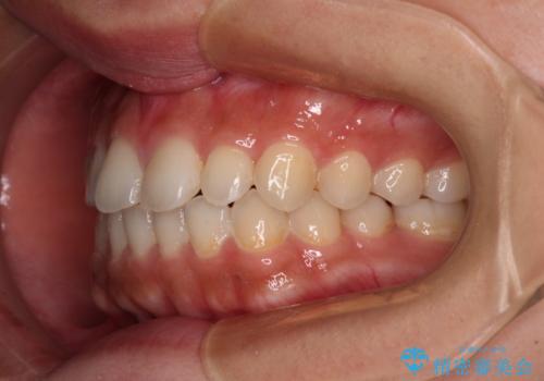 インビザラインを用いた上顎の部分矯正の治療中