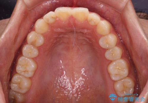 インビザラインを用いた上顎の部分矯正の治療中