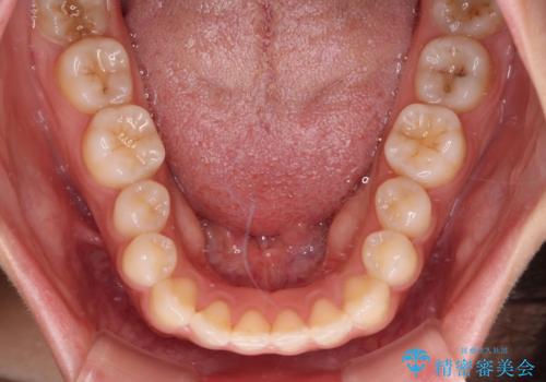 インビザラインを用いた上顎の部分矯正の治療中