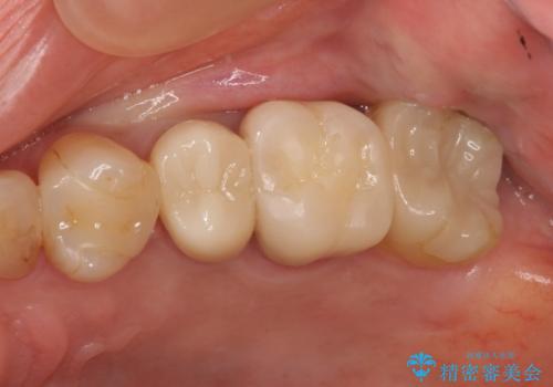 他院で抜歯と言われた 残したいの治療後