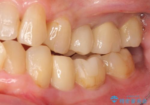 他院で抜歯と言われた 残したいの治療後