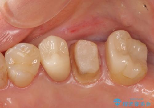 他院で抜歯と言われた 残したいの治療中