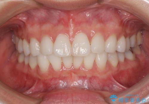 海外で仕事をしながらインビザラインで矯正治療の症例 治療前