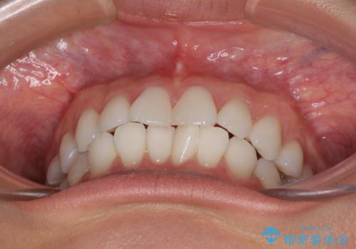 海外で仕事をしながらインビザラインで矯正治療の治療前