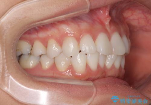 海外で仕事をしながらインビザラインで矯正治療の治療前