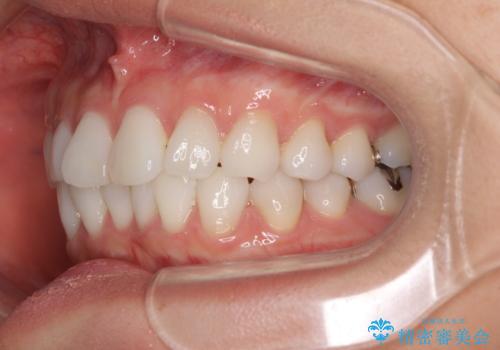 海外で仕事をしながらインビザラインで矯正治療の治療前