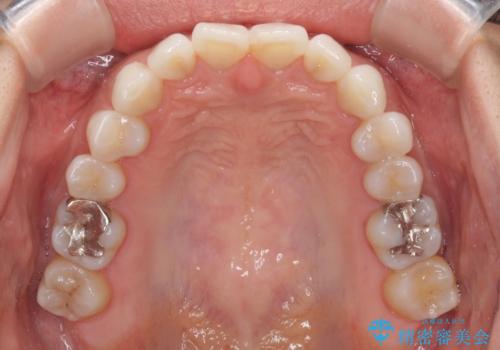 海外で仕事をしながらインビザラインで矯正治療の治療前