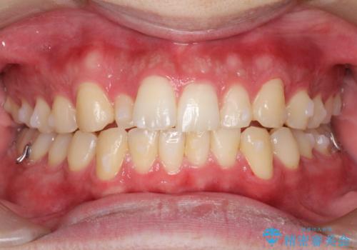 『目立たない装置で前歯のガタガタを治したい』インビザライン症例の治療中