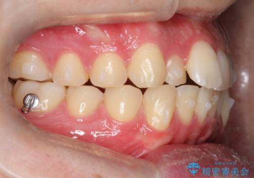 『目立たない装置で前歯のガタガタを治したい』インビザライン症例の治療中