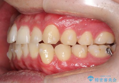 『目立たない装置で前歯のガタガタを治したい』インビザライン症例の治療中