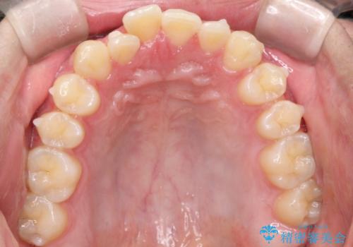 『目立たない装置で前歯のガタガタを治したい』インビザライン症例の治療中