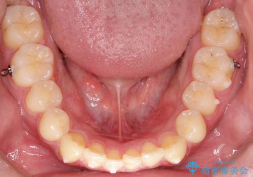 『目立たない装置で前歯のガタガタを治したい』インビザライン症例の治療中