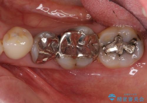 下の銀歯をセラミックに　虫歯治療の症例 治療前